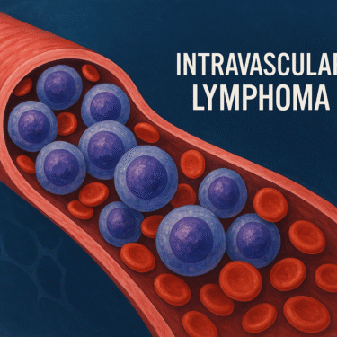 血管内リンパ腫(IVL)